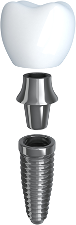 Parts of a dental implant
