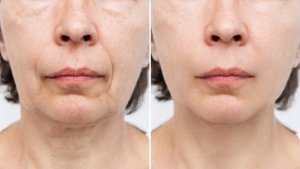 Before and after comparison of a woman's lower face showing the results of a facelift procedure