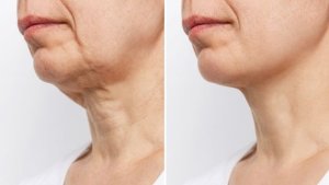 Before and after comparison of a woman's lower face showing the results of a facelift procedure
