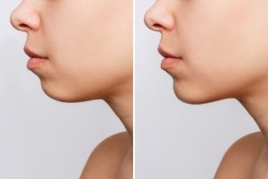 Before and after side profile comparison of a person showing the results of genioplasty (chin surgery)