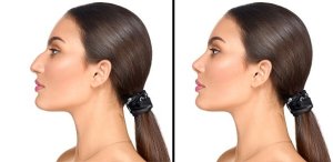 Before and after side profile comparison of a woman showing the results of a rhinoplasty (nose job) procedure.